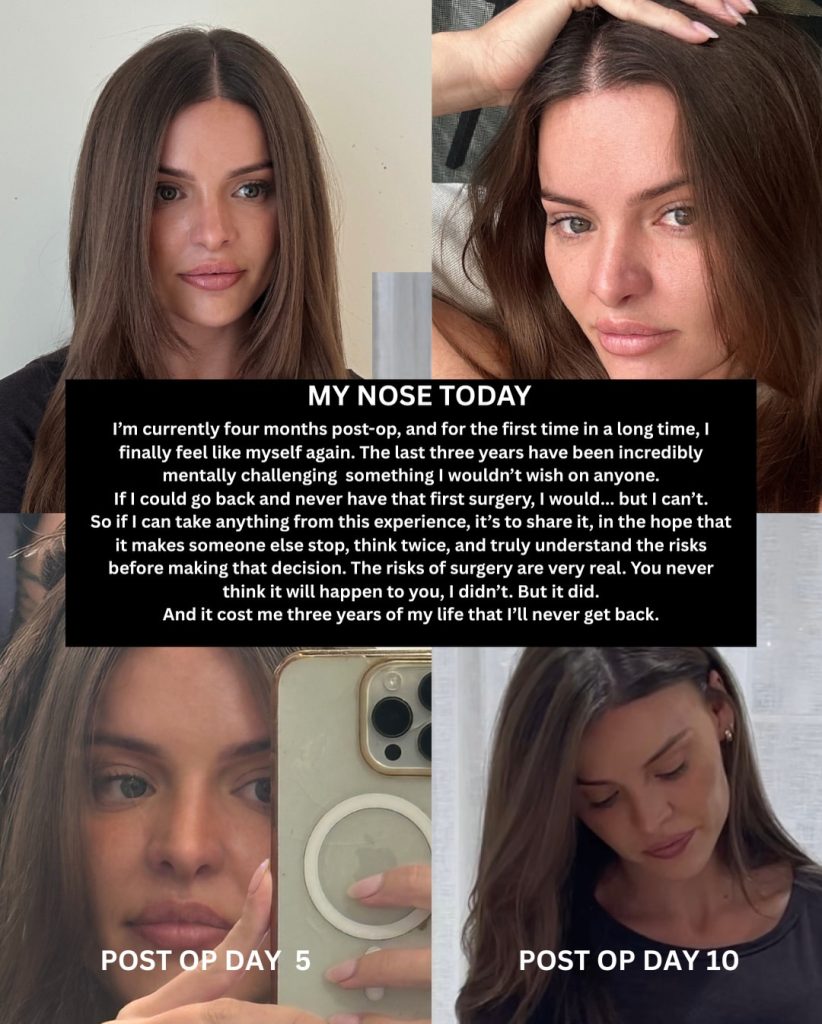 Australian influencer shares the heartbreaking warning after her botched Turkey nose job left her face collapsing - costing her nearly 39,000 pounds and three surgeries.