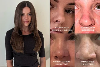 Australian influencer shares the heartbreaking warning after her botched Turkey nose job left her face collapsing - costing her nearly 39,000 pounds and three surgeries.