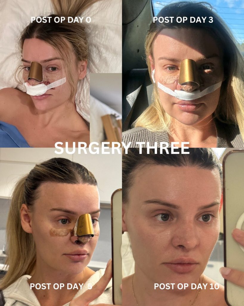 Australian influencer shares the heartbreaking warning after her botched Turkey nose job left her face collapsing - costing her nearly 39,000 pounds and three surgeries.