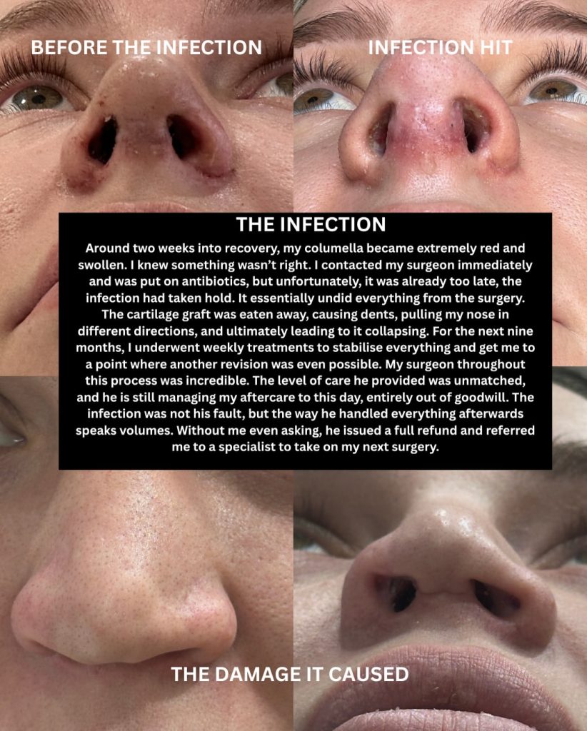 Australian influencer shares the heartbreaking warning after her botched Turkey nose job left her face collapsing - costing her nearly 39,000 pounds and three surgeries.