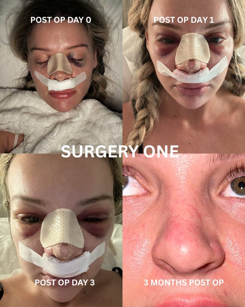 Australian influencer shares the heartbreaking warning after her botched Turkey nose job left her face collapsing - costing her nearly 39,000 pounds and three surgeries.