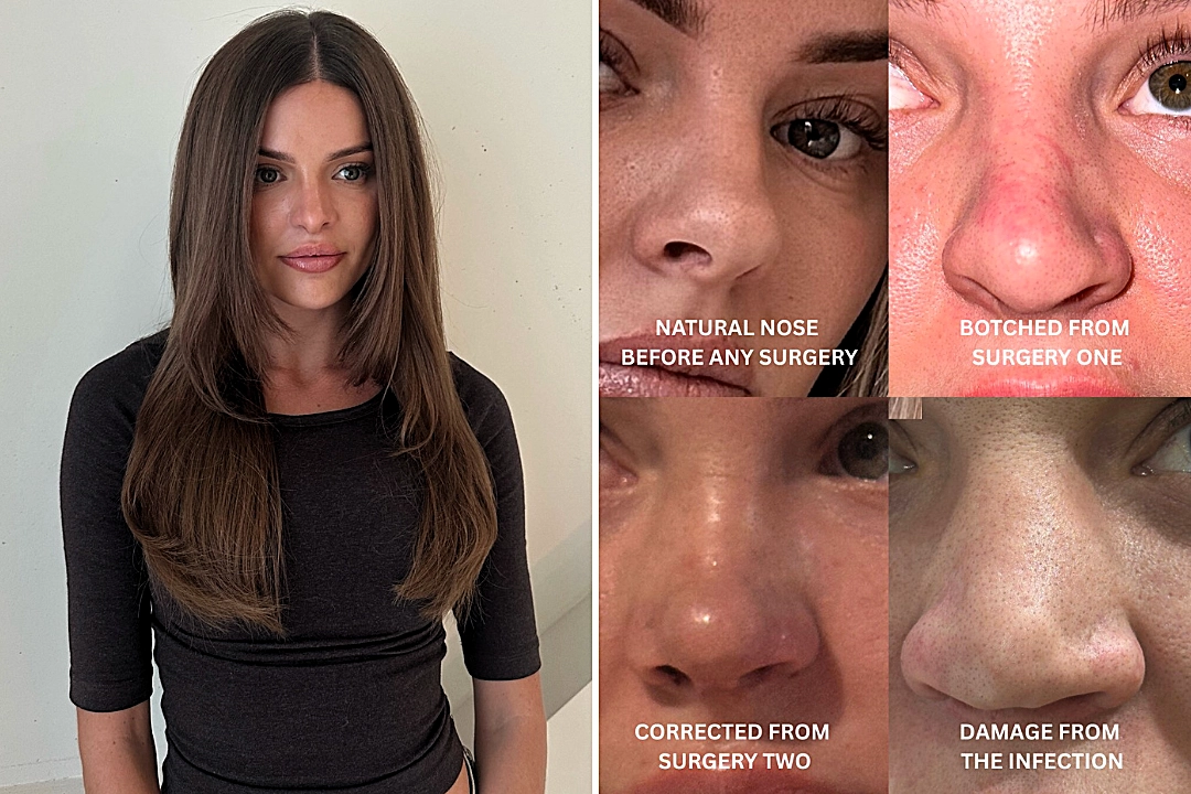 Australian influencer shares the heartbreaking warning after her botched Turkey nose job left her face collapsing - costing her nearly 39,000 pounds and three surgeries.