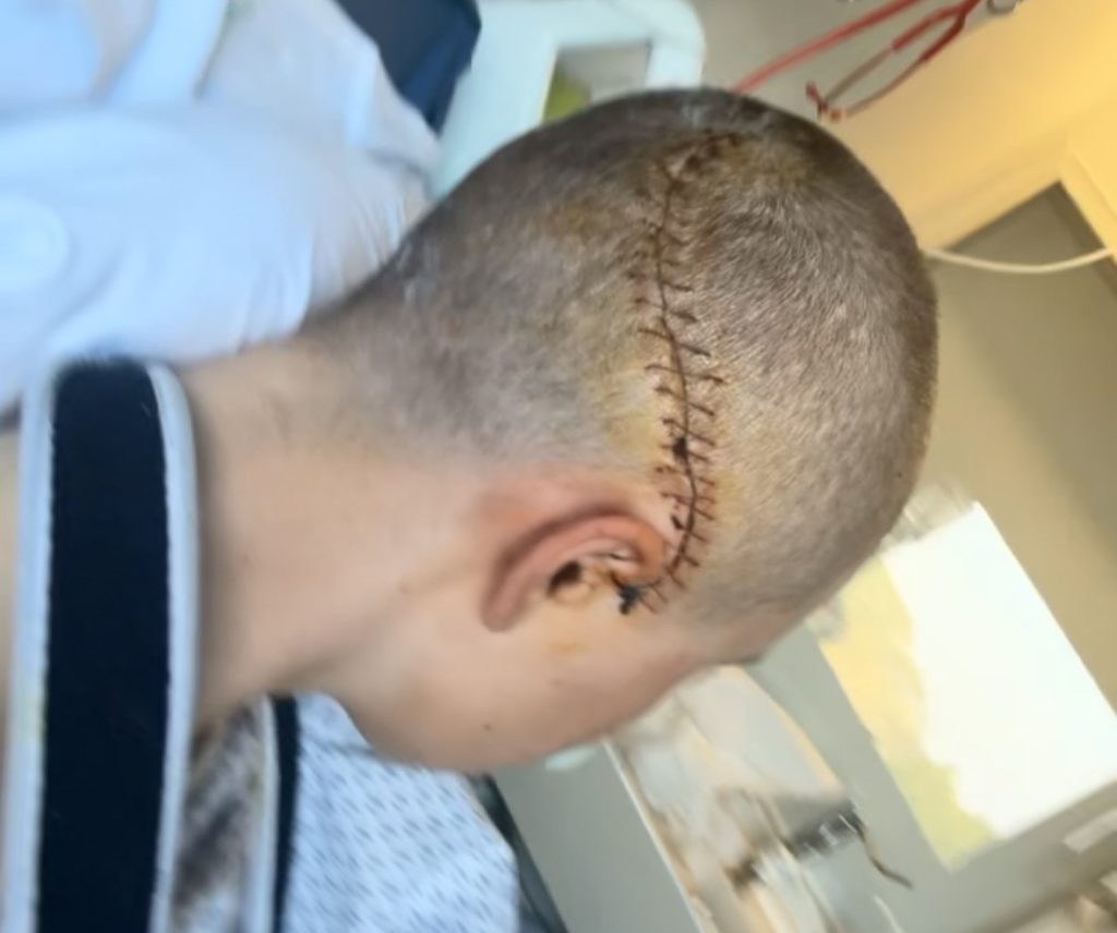 Pro cyclist Kamilla Aasebø, 19, has shared her shocking scar after a Paris-Roubaix crash left her with a brain bleed that required emergency surgery and left her fighting to walk.