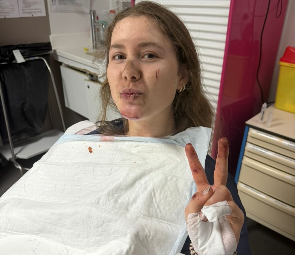 Pro cyclist Kamilla Aasebø, 19, has shared her shocking scar after a Paris-Roubaix crash left her with a brain bleed that required emergency surgery and left her fighting to walk.