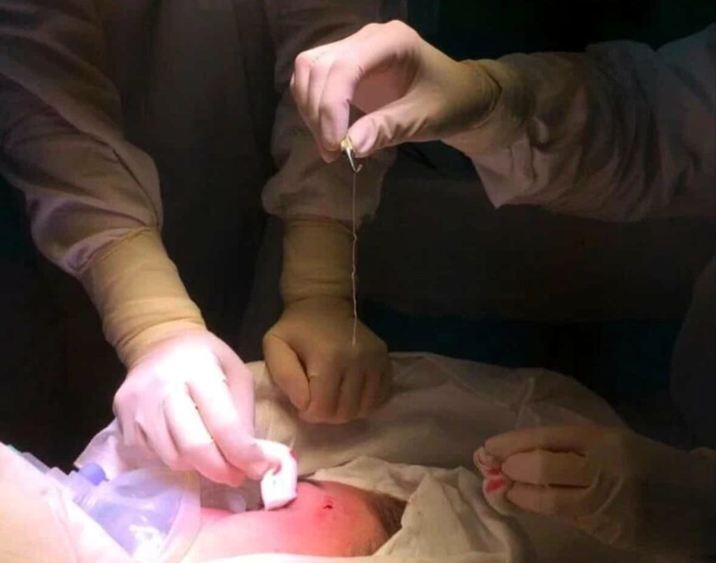 Woman reveals she spent an entire year with a horrifying 15cm worm living under her skin - and you'll never believe how doctors finally discovered it.