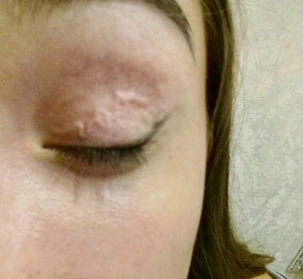Woman reveals she spent an entire year with a horrifying 15cm worm living under her skin - and you'll never believe how doctors finally discovered it.