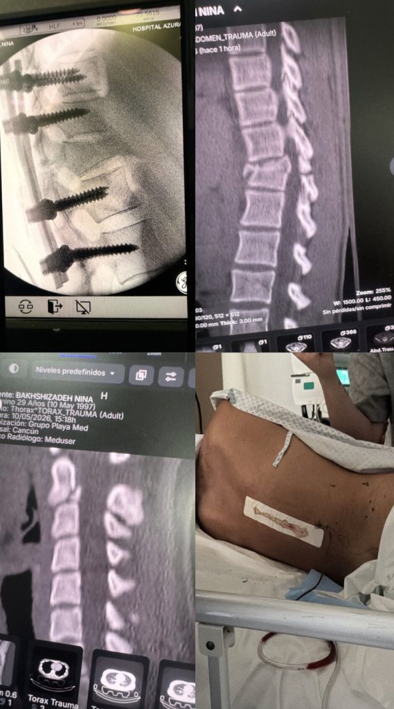 Nina Bakhshi faces long recovery after birthday trip turned nightmare when she fell from bridge in Mexico, suffering severe spinal and neck injuries without insurance.