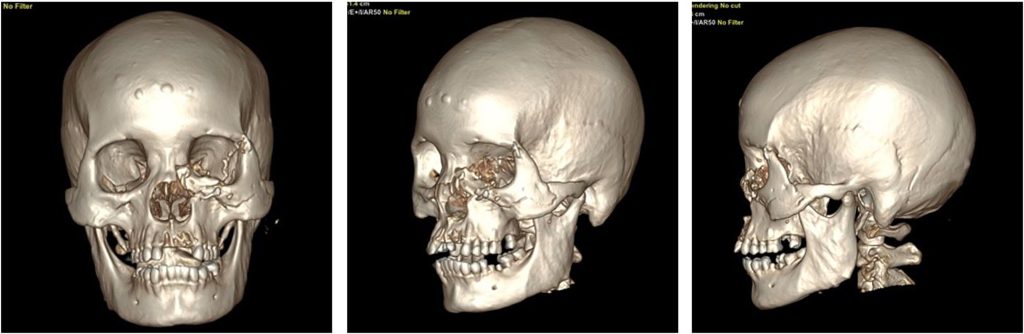 Woman has half her face ripped off by a bear in a horrific attack while working on a coffee plantation - and is dragged 10 metres along the ground.