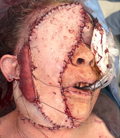 Woman, 69, has half her face and eye surgically removed after rare aggressive skin cancer spread across her face - following 4-year battle and two organ transplants.