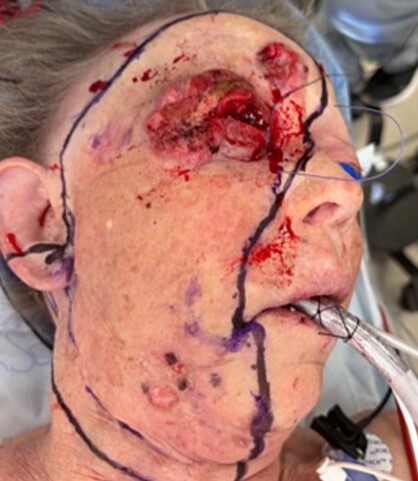 Woman, 69, has half her face and eye surgically removed after rare aggressive skin cancer spread across her face - following 4-year battle and two organ transplants.
