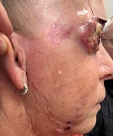 Woman, 69, has half her face and eye surgically removed after rare aggressive skin cancer spread across her face - following 4-year battle and two organ transplants.