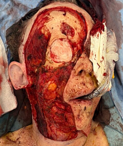 Woman, 69, has half her face and eye surgically removed after rare aggressive skin cancer spread across her face - following 4-year battle and two organ transplants.
