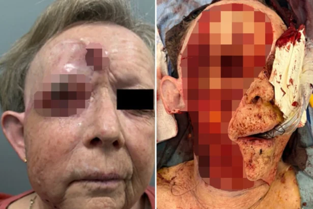 Woman, 69, has half her face and eye surgically removed after rare aggressive skin cancer spread across her face - following 4-year battle and two organ transplants.