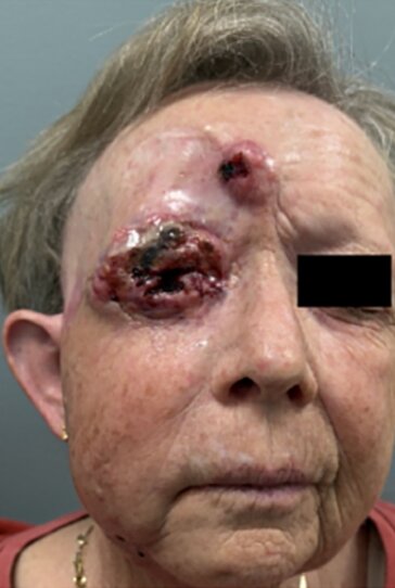 Woman, 69, has half her face and eye surgically removed after rare aggressive skin cancer spread across her face - following 4-year battle and two organ transplants.