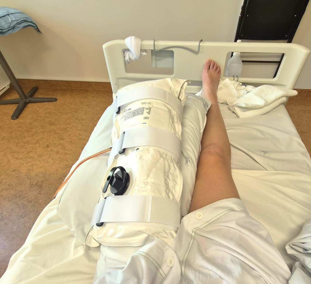 Swedish woman becomes the first person in the country to undergo a groundbreaking amputation - and says she can already feel her missing foot moving again.
