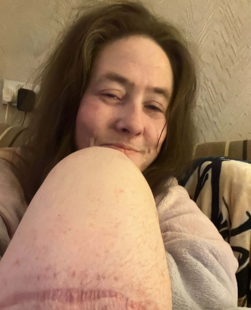 Type 1 diabetic Jayme Stephen, 39, had her leg amputated after accidentally standing on a dropped dog biscuit triggered a horror sepsis infection.