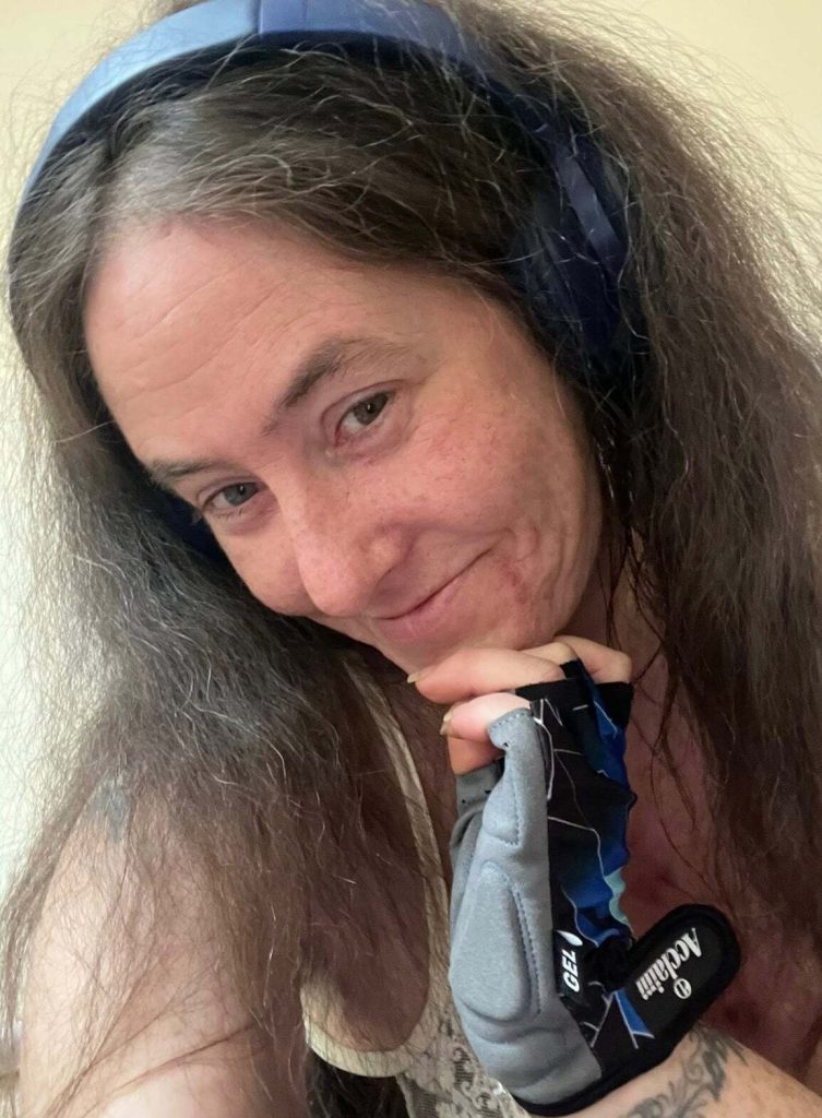 Type 1 diabetic Jayme Stephen, 39, had her leg amputated after accidentally standing on a dropped dog biscuit triggered a horror sepsis infection.