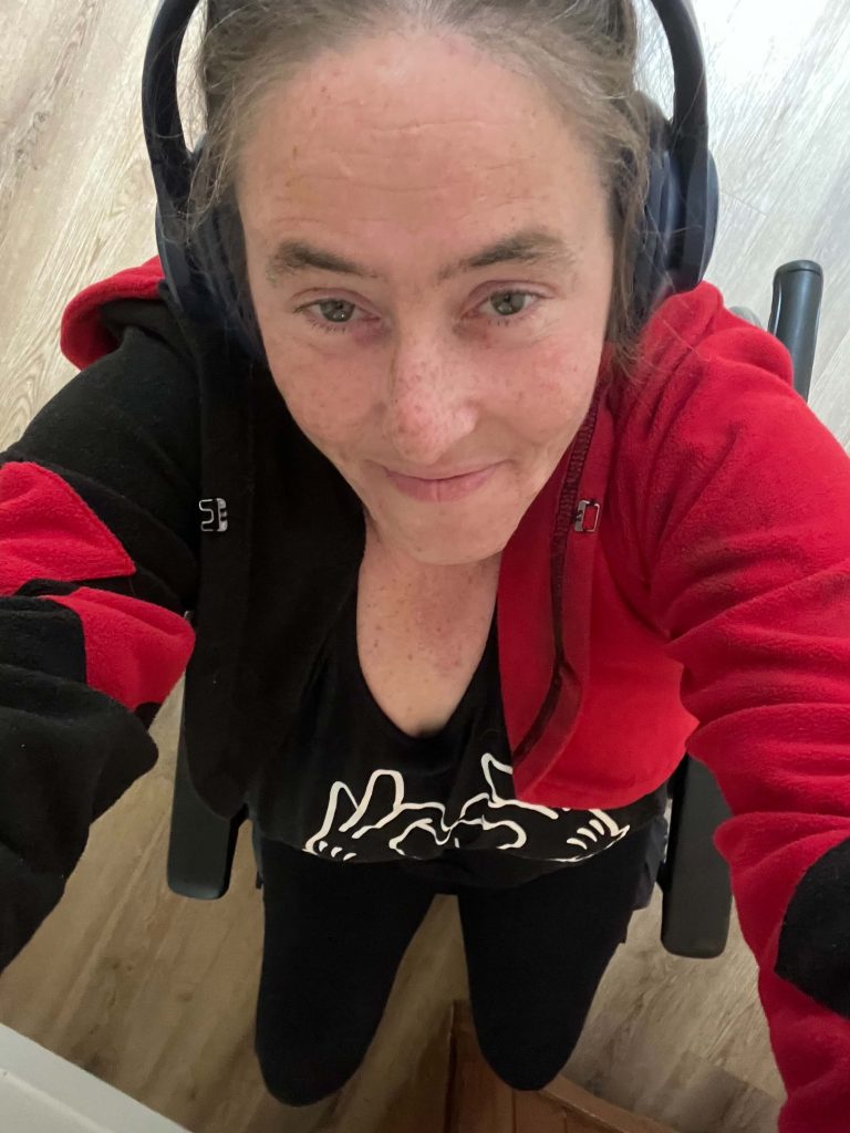Type 1 diabetic Jayme Stephen, 39, had her leg amputated after accidentally standing on a dropped dog biscuit triggered a horror sepsis infection.