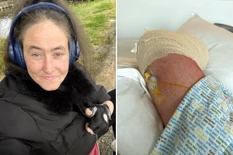 Type 1 diabetic Jayme Stephen, 39, had her leg amputated after accidentally standing on a dropped dog biscuit triggered a horror sepsis infection.