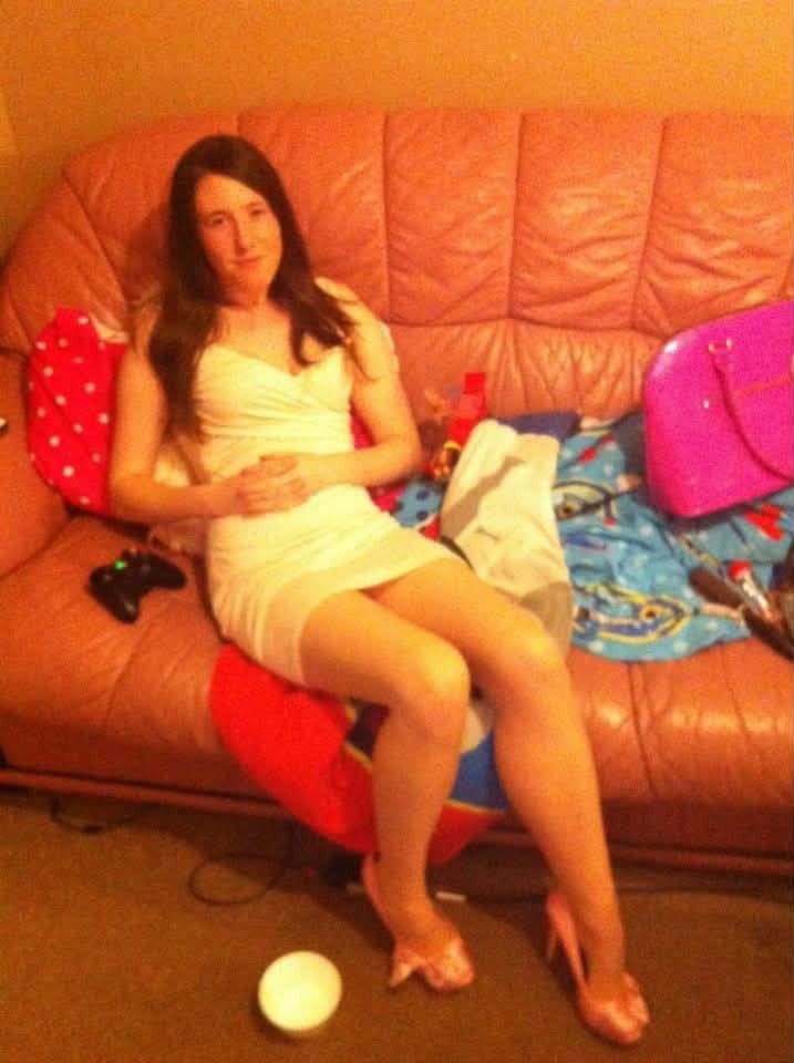 Type 1 diabetic Jayme Stephen, 39, had her leg amputated after accidentally standing on a dropped dog biscuit triggered a horror sepsis infection.