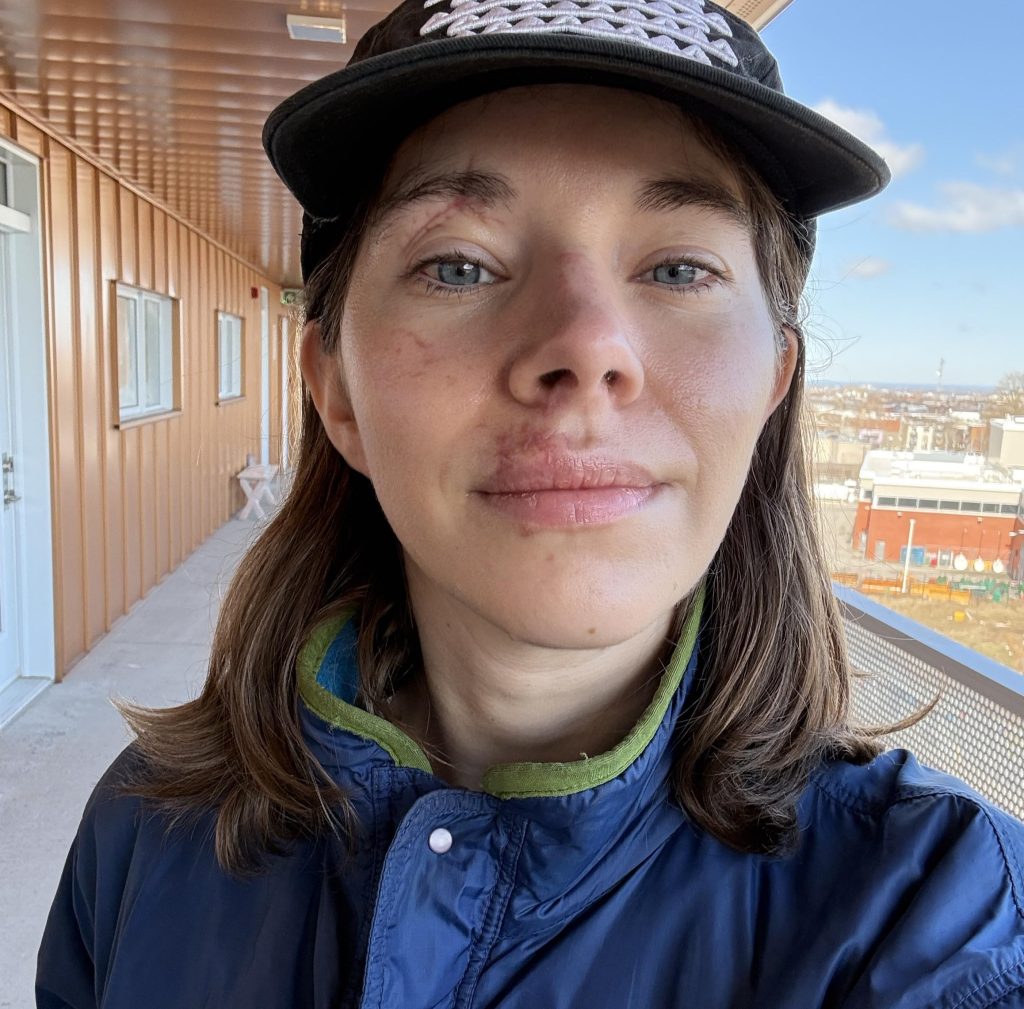 Alexie shattered her face in a horror hiking fall and covered every mirror at home - now she's sharing her raw recovery journey to help others heal.