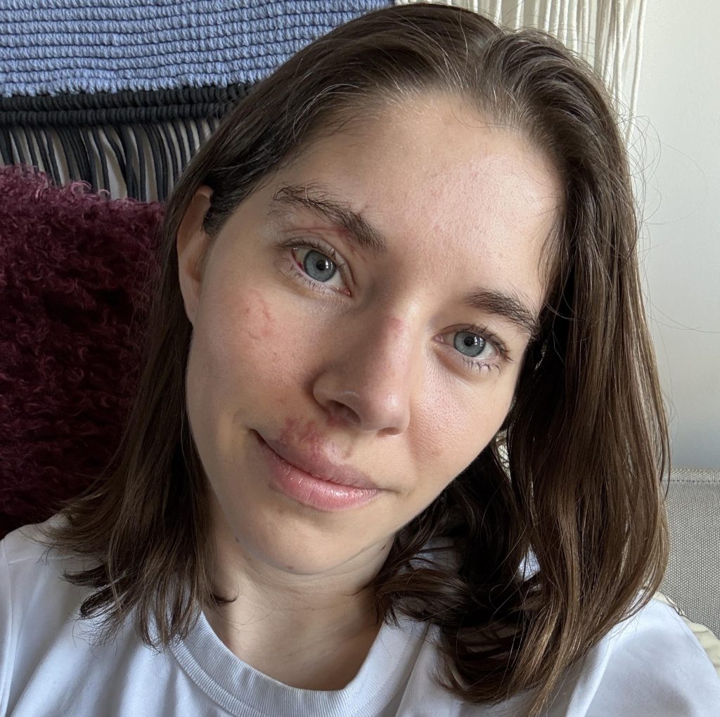 Alexie shattered her face in a horror hiking fall and covered every mirror at home - now she's sharing her raw recovery journey to help others heal.