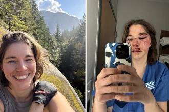 Alexie shattered her face in a horror hiking fall and covered every mirror at home - now she's sharing her raw recovery journey to help others heal.