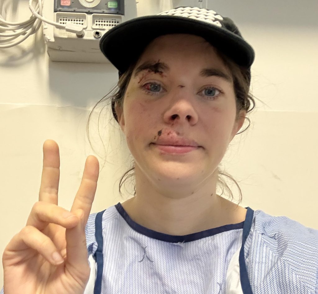 Alexie shattered her face in a horror hiking fall and covered every mirror at home - now she's sharing her raw recovery journey to help others heal.