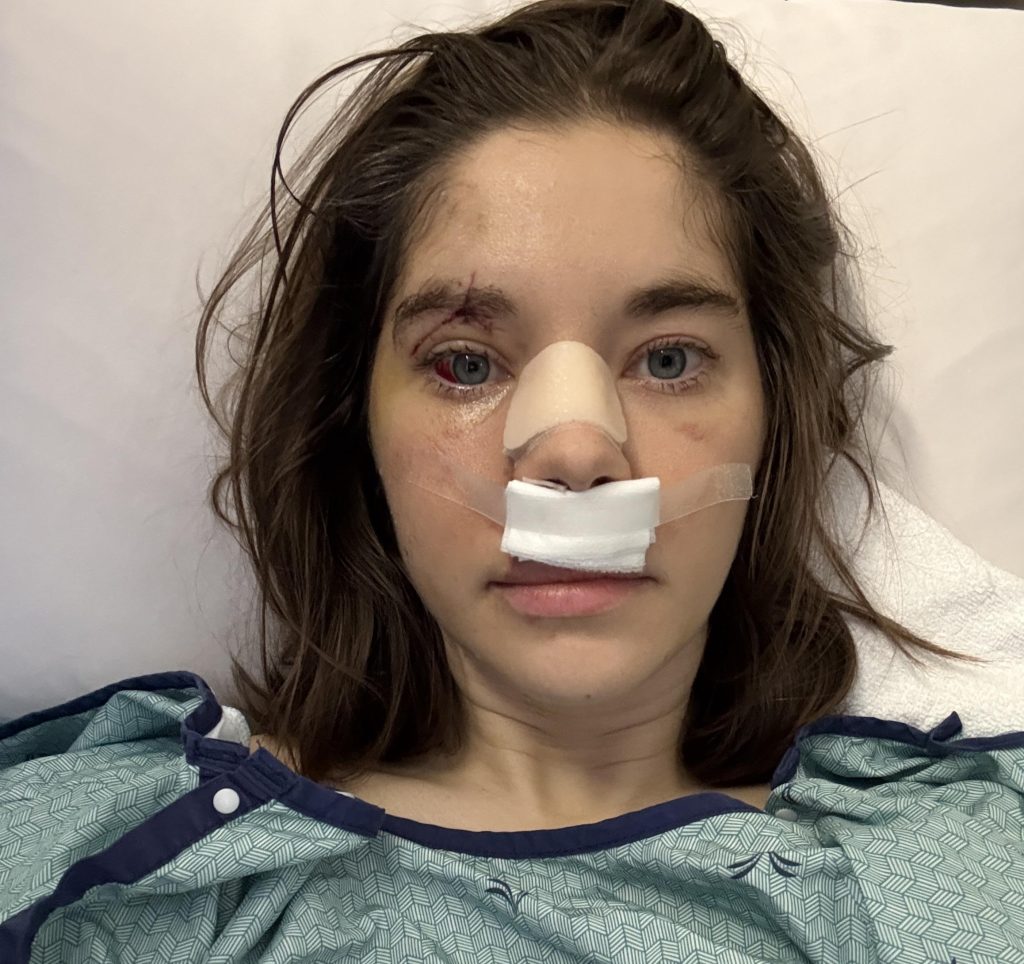 Alexie shattered her face in a horror hiking fall and covered every mirror at home - now she's sharing her raw recovery journey to help others heal.