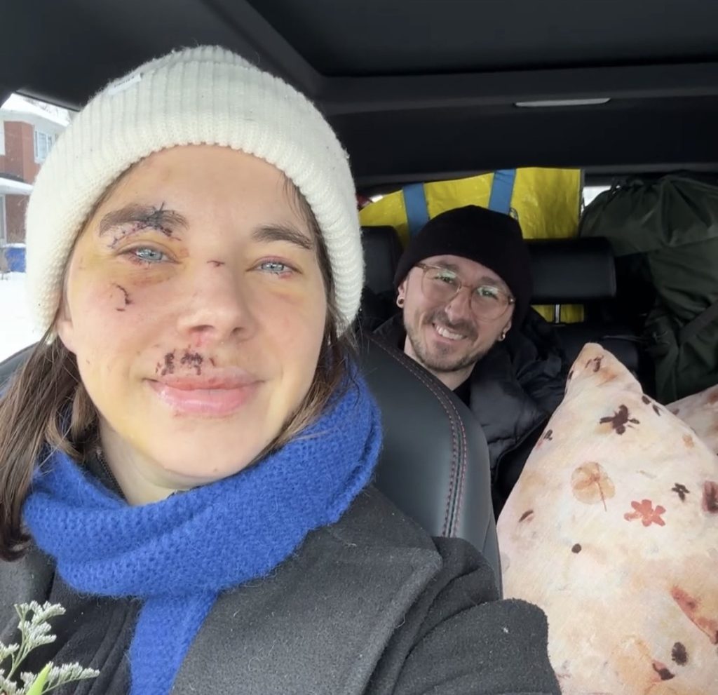 Alexie shattered her face in a horror hiking fall and covered every mirror at home - now she's sharing her raw recovery journey to help others heal.