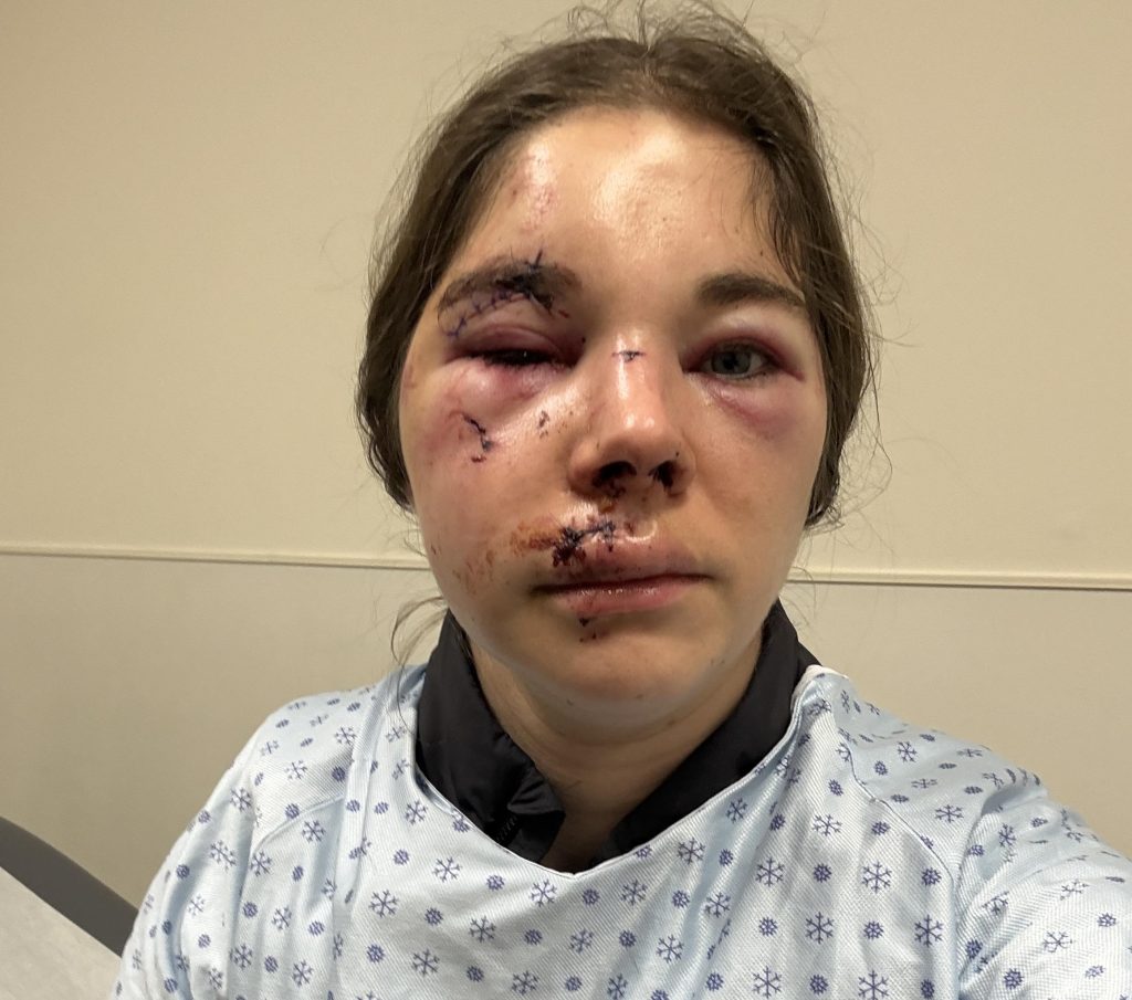 Alexie shattered her face in a horror hiking fall and covered every mirror at home - now she's sharing her raw recovery journey to help others heal.