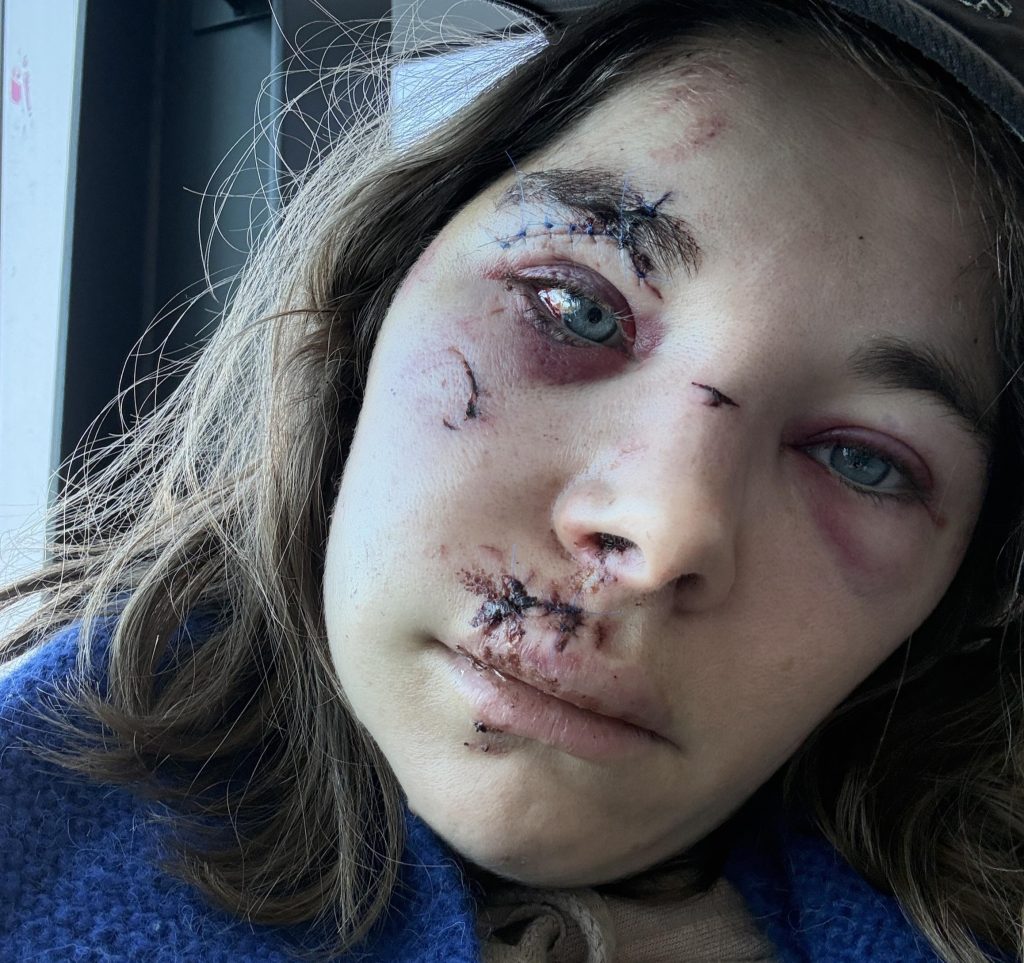 Alexie shattered her face in a horror hiking fall and covered every mirror at home - now she's sharing her raw recovery journey to help others heal.