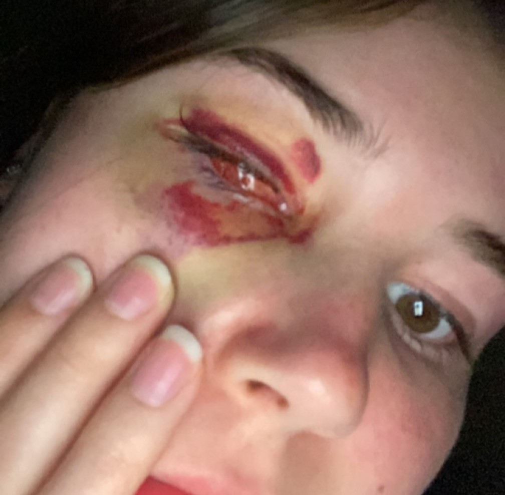 Student with rare eye cancer reveals the heartbreaking moment she first saw herself in the mirror after surgery to remove her eye - and how she learned to accept it.