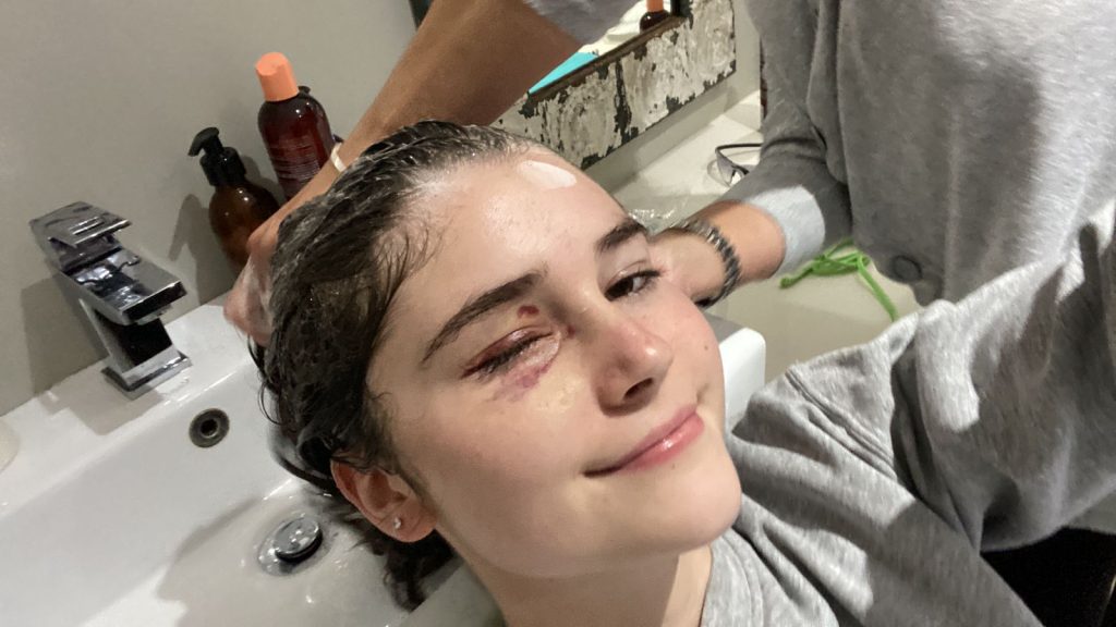 Student with rare eye cancer reveals the heartbreaking moment she first saw herself in the mirror after surgery to remove her eye - and how she learned to accept it.