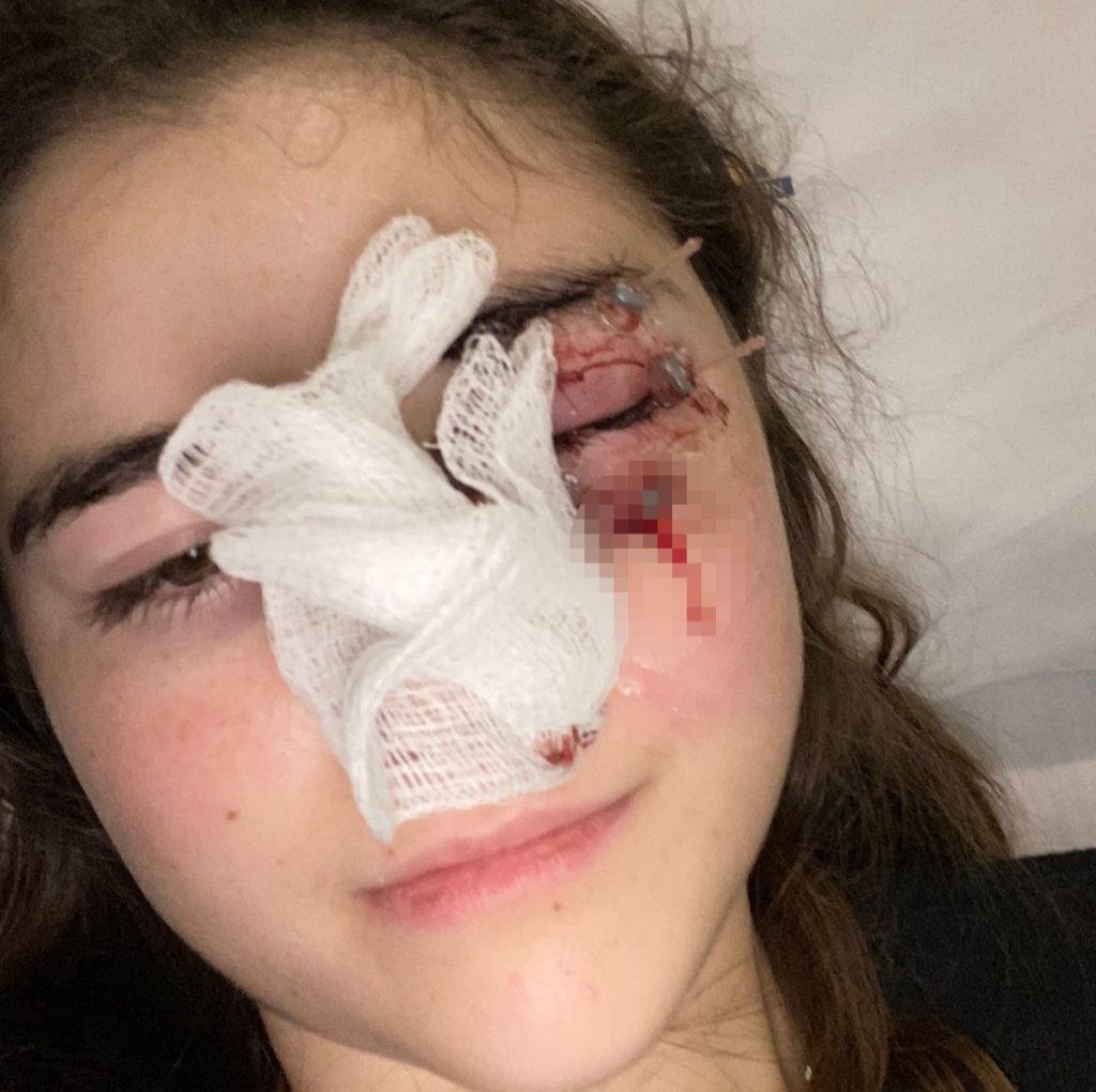 Student with rare eye cancer reveals the heartbreaking moment she first saw herself in the mirror after surgery to remove her eye - and how she learned to accept it.