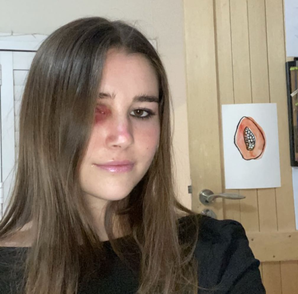 Student with rare eye cancer reveals the heartbreaking moment she first saw herself in the mirror after surgery to remove her eye - and how she learned to accept it.