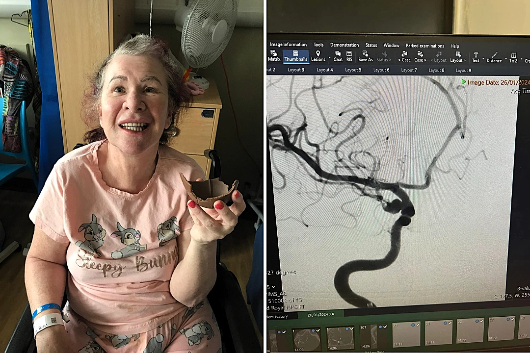 Woman left unconscious for two weeks after a terrifying bleed on the brain reveals her harrowing ordeal - and the devastating reason it could all happen again.