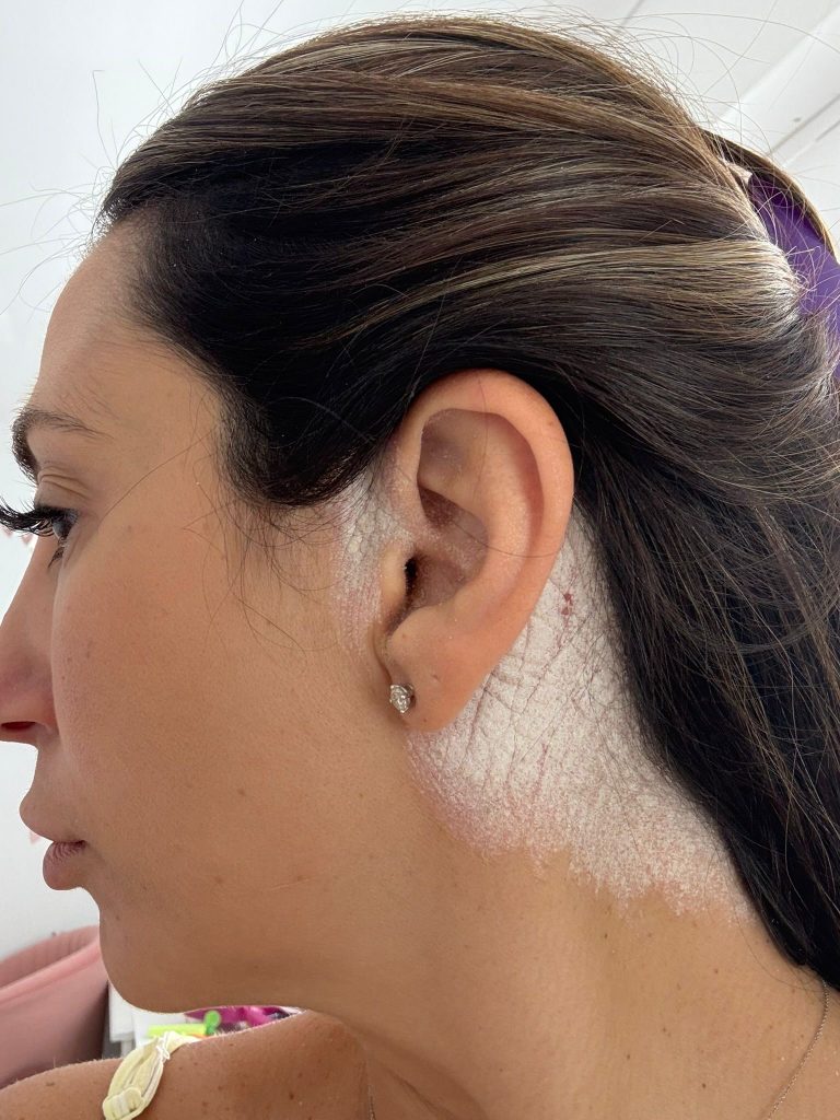 Mum Ellena George, 38, was cruelly called a snake by trolls due to her psoriasis but has finally found relief with a game-changing £12 shampoo.