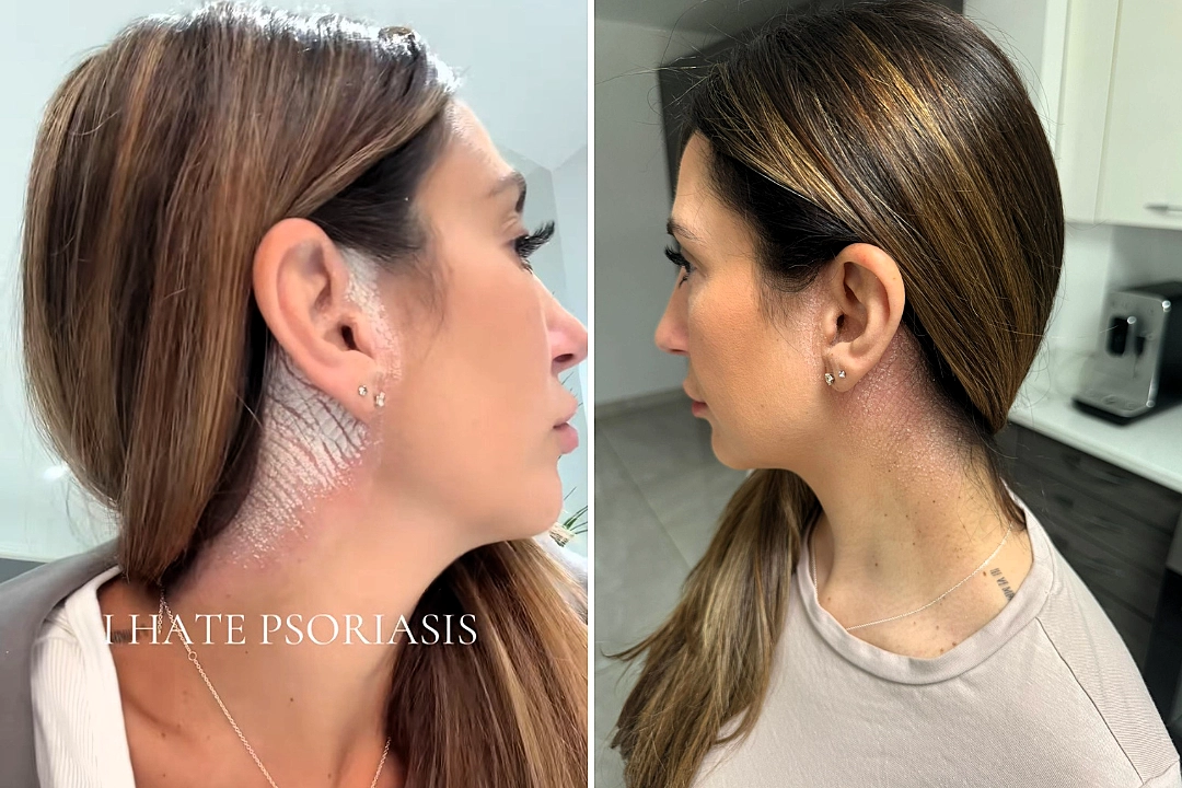 Mum Ellena George, 38, was cruelly called a snake by trolls due to her psoriasis but has finally found relief with a game-changing £12 shampoo.