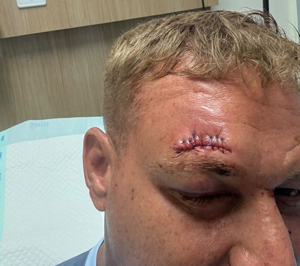 A British tourist claims he was drugged and robbed of £1,800 in Bali after a woman spiked his drinks on a night out - leaving him with two head wounds and 23 stitches.