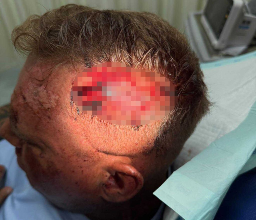 A British tourist claims he was drugged and robbed of £1,800 in Bali after a woman spiked his drinks on a night out - leaving him with two head wounds and 23 stitches.