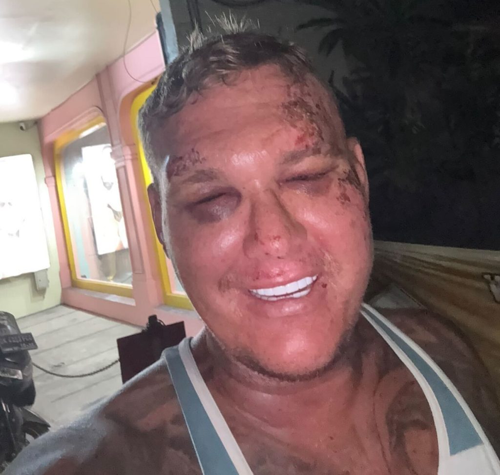 A British tourist claims he was drugged and robbed of £1,800 in Bali after a woman spiked his drinks on a night out - leaving him with two head wounds and 23 stitches.
