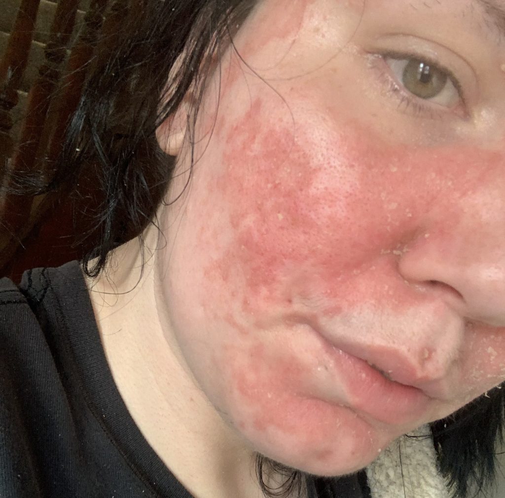 An NHS healthcare assistant spent five years battling stroke-like symptoms doctors called a mystery - at 29 she was finally diagnosed with multiple sclerosis and is now living again.