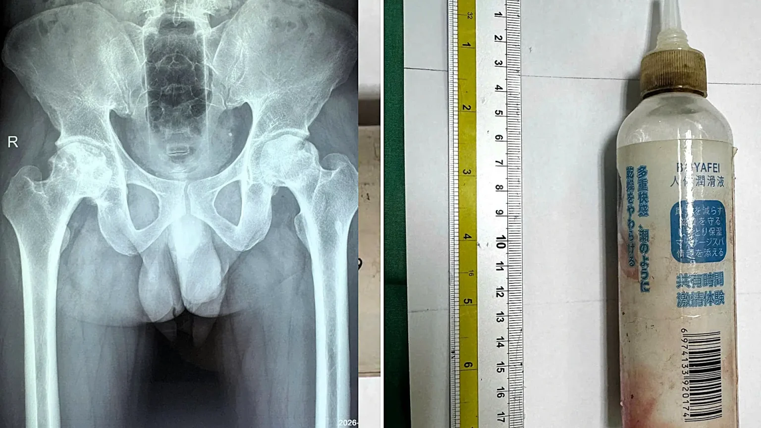 Doctors in Vietnam surgically removed a 20cm plastic bottle from a man's rectum after he allegedly inserted it to clean himself and failed to retrieve it himself.