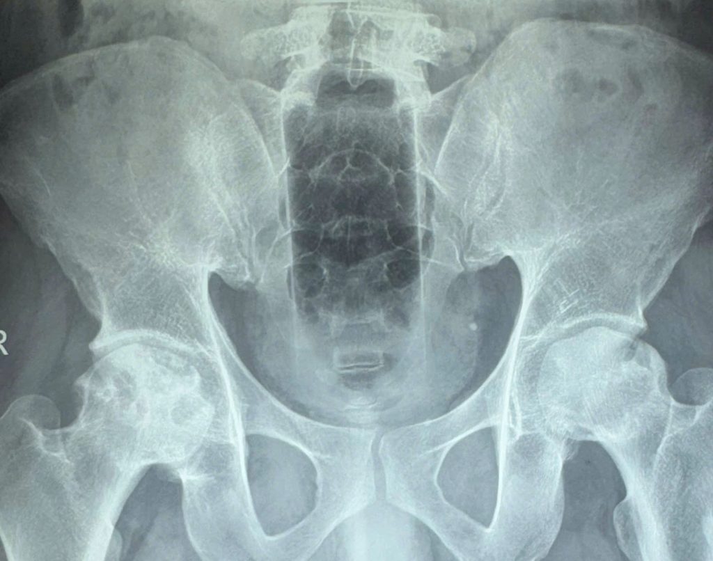 Doctors in Vietnam surgically removed a 20cm plastic bottle from a man's rectum after he allegedly inserted it to clean himself and failed to retrieve it himself.