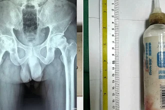 Doctors in Vietnam surgically removed a 20cm plastic bottle from a man's rectum after he allegedly inserted it to clean himself and failed to retrieve it himself.
