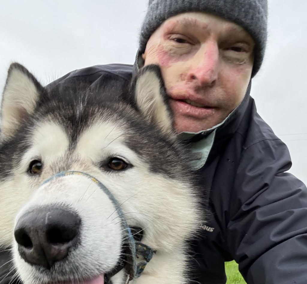 Pilot who could smell his own flesh burning as his plane caught fire at 32 reveals the daily five-mile walk he does to "survive" after burns to 63% of his body.