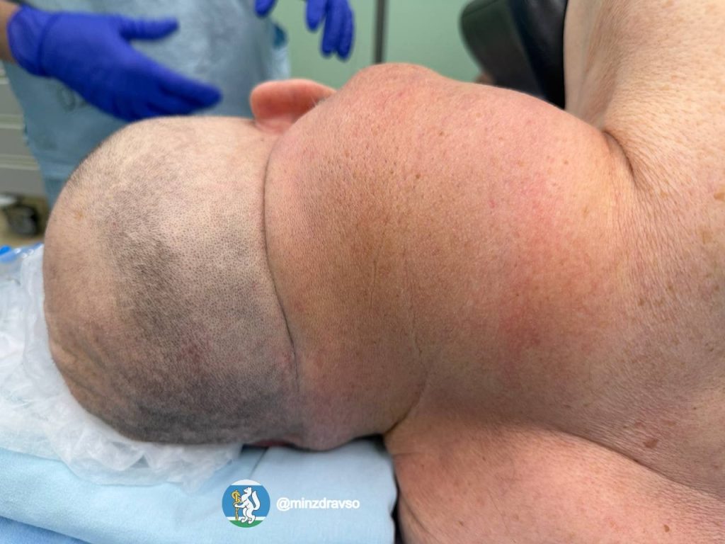 Russian surgeons spent two hours removing a rare neck liposarcoma the size of a human head from an elderly man, after the 2kg tumour had begun advancing towards his spine.
