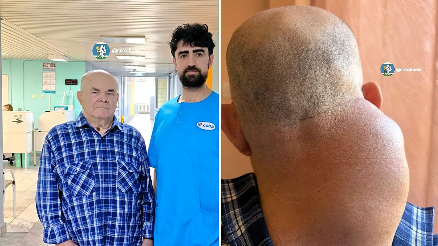 Russian surgeons spent two hours removing a rare neck liposarcoma the size of a human head from an elderly man, after the 2kg tumour had begun advancing towards his spine.