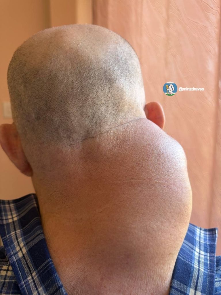 Russian surgeons spent two hours removing a rare neck liposarcoma the size of a human head from an elderly man, after the 2kg tumour had begun advancing towards his spine.